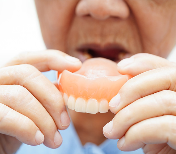 入れ歯（義歯）